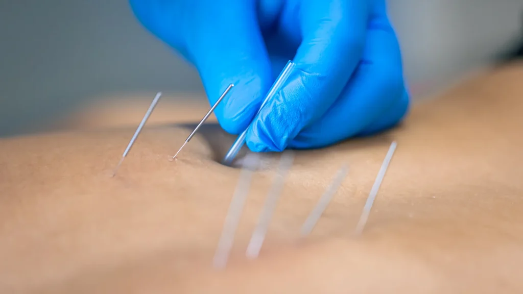 Close-up of acupuncture needles being inserted into a patient’s back by a practitioner for Chinese medicine treatment.