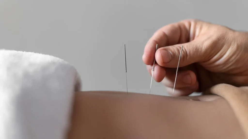 Close up of a women getting acupuncture in her abdomen.