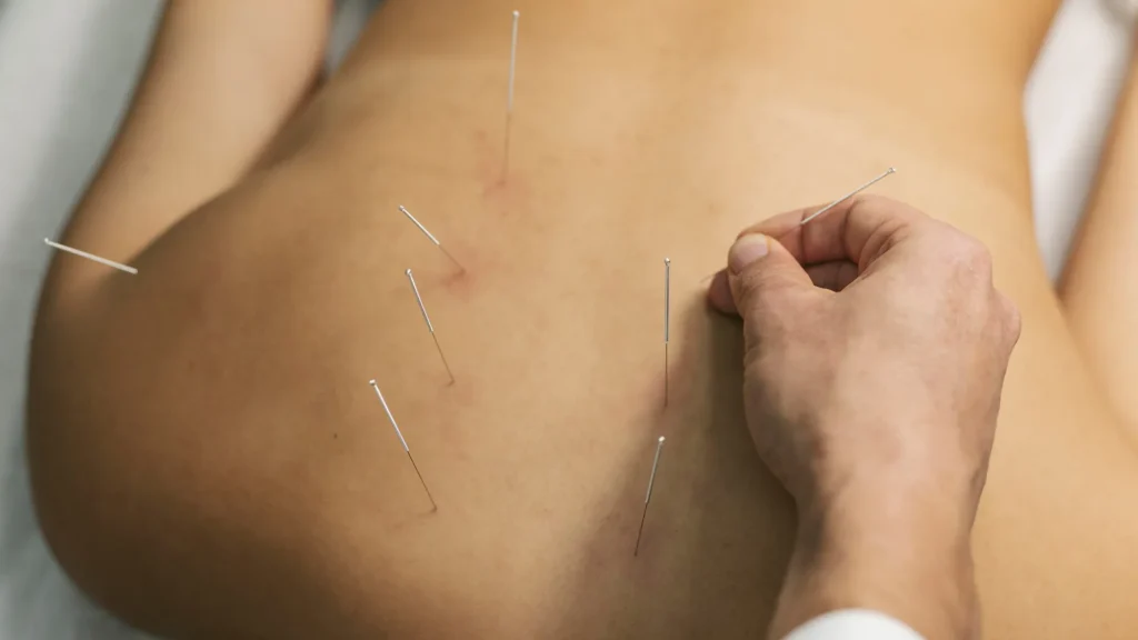 A person getting an Acupuncture