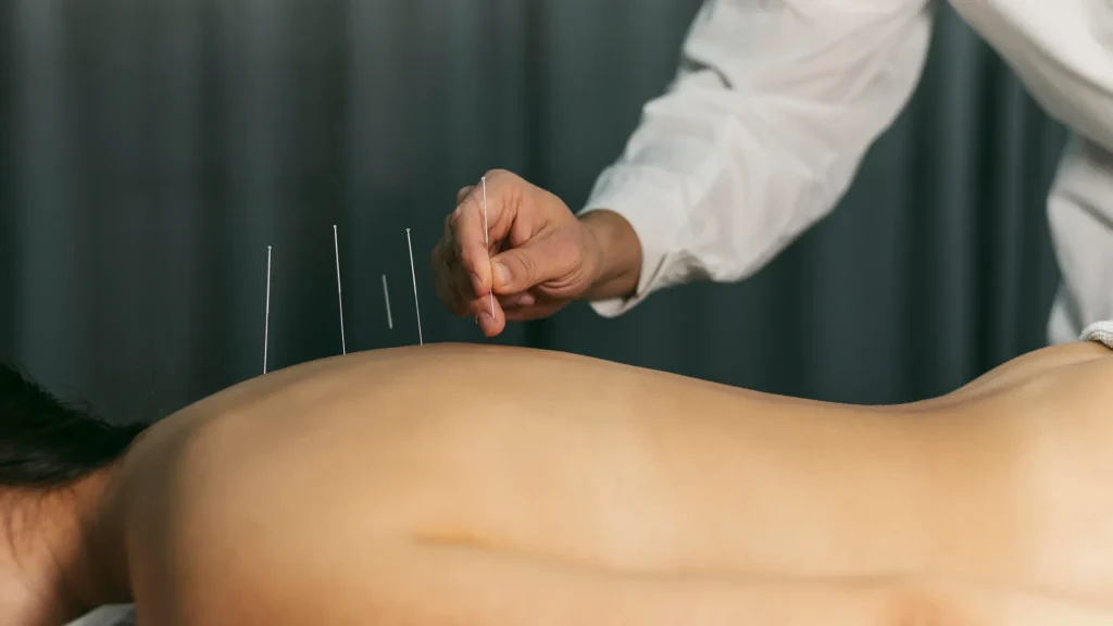Acupuncture for pain relief: A practitioner placing needles into a patient's back to treat sciatica and headaches.